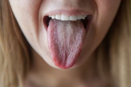 Белый налет на языке у взрослых - причины, лечение, симптомы 2