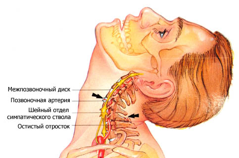 Остеохондроз шейного отдела позвоночника симптомы и лечение 2