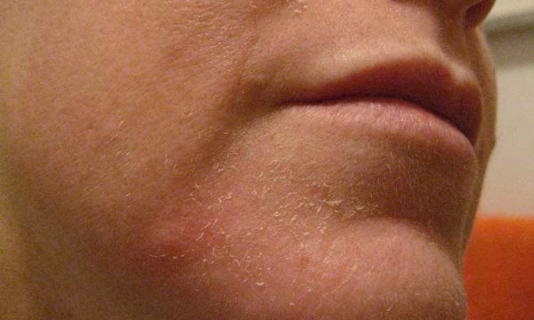 Покраснение и шелушение кожи на лице - что делать, лечение 1