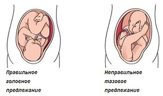 Дисплазия тазобедренных суставов у ребенка - причины и лечение 2