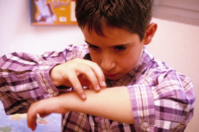 Аллергия на сладкое у детей - причины, симптомы, что делать 2