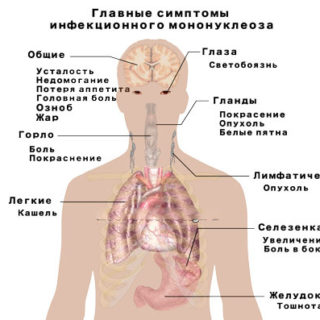 Инфекционный мононуклеоз у детей - симптомы и лечение 2