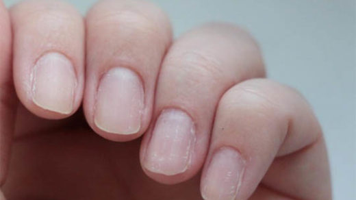 Ломкие ногти на руках - причины и лечение, как начать восстановление 1