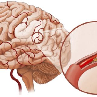 Спазм сосудов головного мозга - причины, симптомы, лечение 2