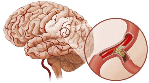 Спазм сосудов головного мозга - причины, симптомы, лечение 2