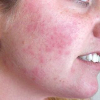 Чем лечить аллергию на лице - основные причины, лечение, что делать 2