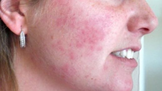 Чем лечить аллергию на лице - основные причины, лечение, что делать 2