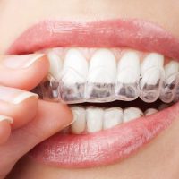 Как отбелить зубы в домашних условиях - эффективные способы 1