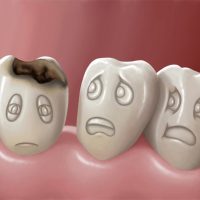 Кариес зубов - лечение заболевания, симптомы, профилактика 1