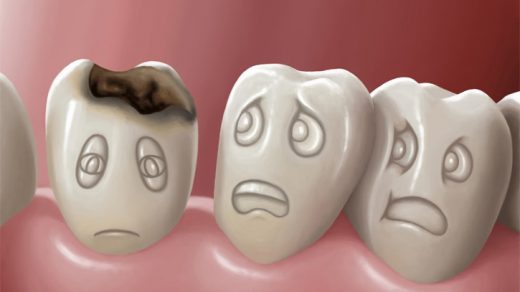 Кариес зубов - лечение заболевания, симптомы, профилактика 1