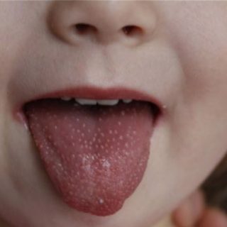 Малиновый язык у ребенка с пупырышками   причины, что делать 1