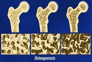 Картинки с днем борьбы с остеопорозом005